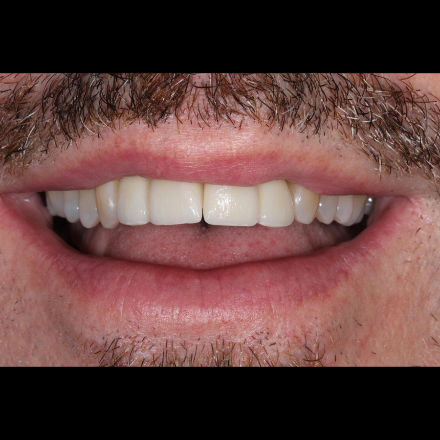 crowns after 3Dental